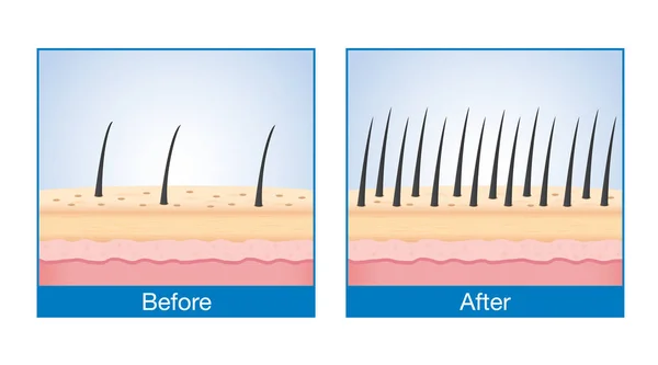 Antal av hår på hårbotten före och efter behandling håravfall. — Stock vektor