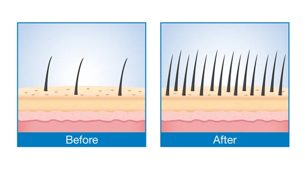 之前和之后的治疗脱发的头皮上的头发数量. — 图库矢量图片