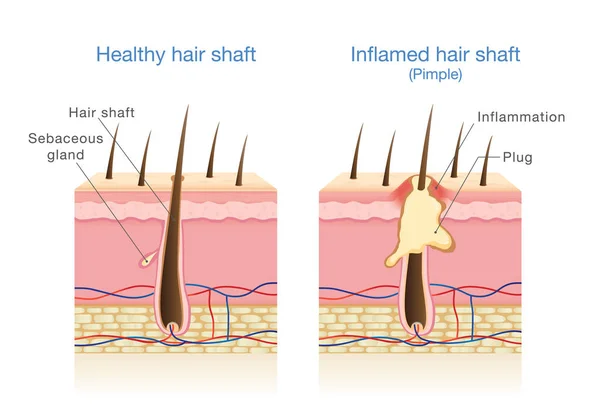 Infektion i hårsäckar. — Stock vektor