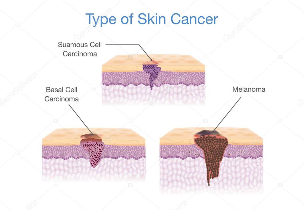 Type of Skin Cancer in 3D vector style.