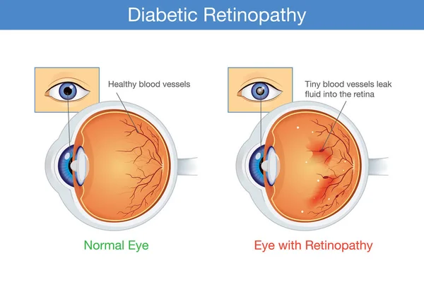 Анатомия нормального глаза и диабетическая ретинопатия . — стоковый вектор