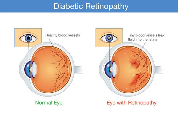 Anatomie van een normaal oog en diabetische retinopathie. — Stockvector