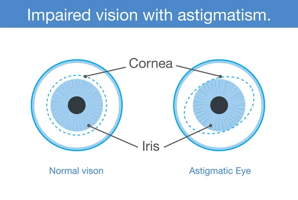 Visión normal y visión deteriorada con astigmatismo en la vista frontal . — Vector de stock