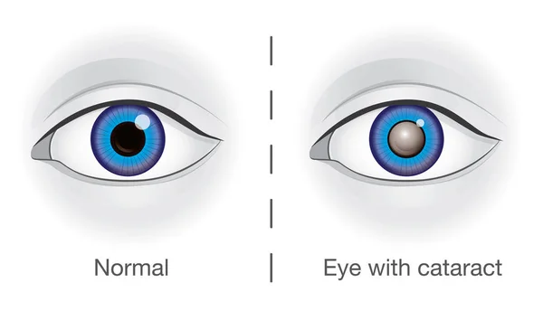Нормальный глаз и хрусталик затуманены катарактой . — стоковый вектор