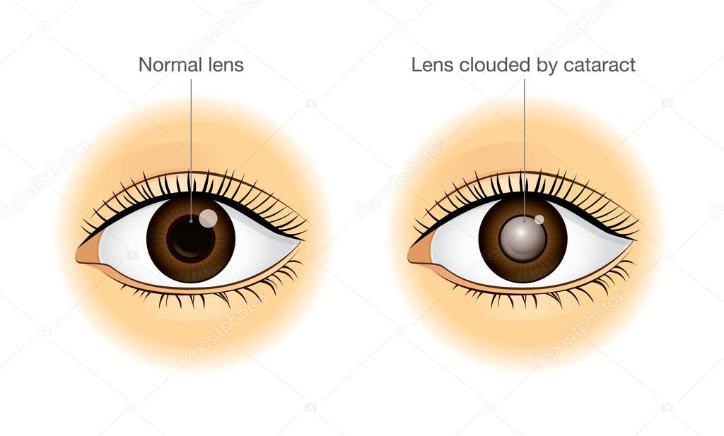 Normal eye and lens clouded by cataract.