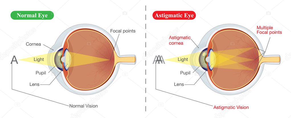 Vision of Normal eye and Astigmatic