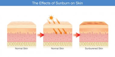 Güneş ışığından zarar insan cilt tabakasının değiştirme.
