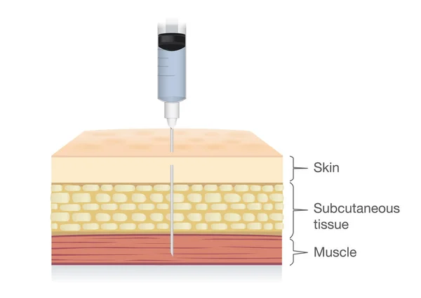 Injection needle insert medications into the muscle layer of skin. — Stock Vector