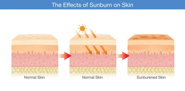 Изменение слоя кожи человека, поврежденного солнечным светом . — стоковый вектор