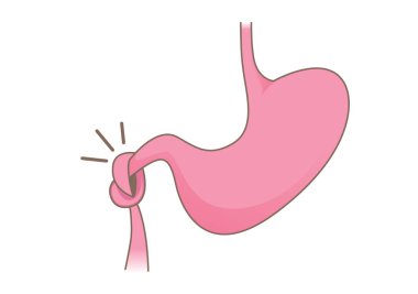 Yüz üstü yat düğüm izole ettim.