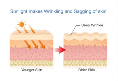 Güneş ışığı sarkma cilt yapar.