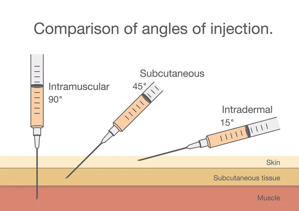 Comparison of the angles of intramuscular injection. — Stock Vector