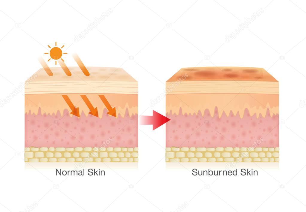 Effect of sunlight on skin.