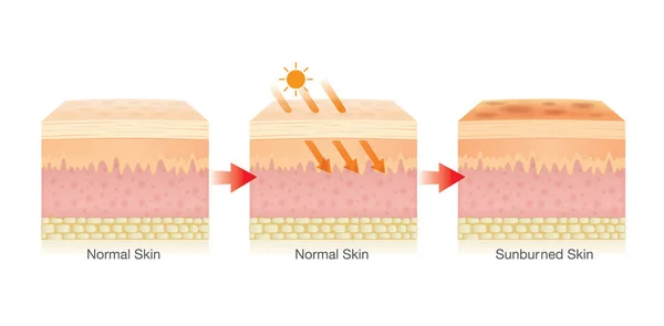 Krok změna vrstvy lidské kůže poškozena od slunečního záření. — Stockový vektor