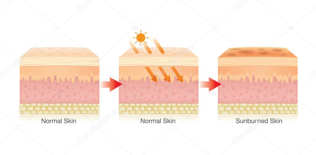 Step of Changing of human skin layer damaged from sunlight.