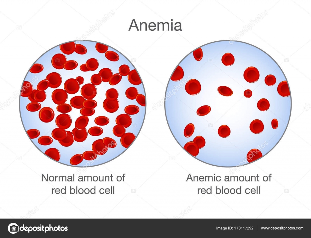 pic Anemia Cartoon Images https depositphotos com 170117292 stock illustration the difference of anemia amount html
