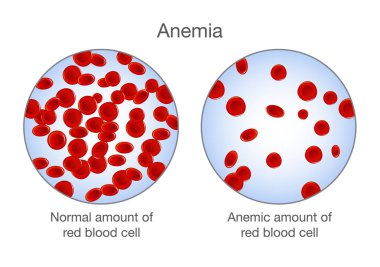 Anemi kırmızı kan hücresi ve normal miktarda fark. 