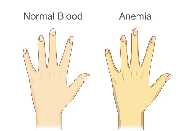 Skillnaden på anemi personer hud och normala människor. — Stock vektor