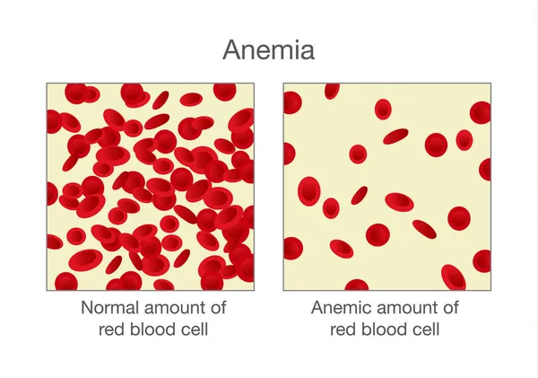 Perbedaan jumlah normal sel darah merah dan Anemia . - Stok Vektor