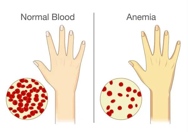 L'effet de l'anémie sur le flux sanguin cutané chez l'homme . — Image vectorielle