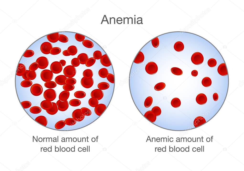 The difference of Anemia amount of red blood cell and normal. 
