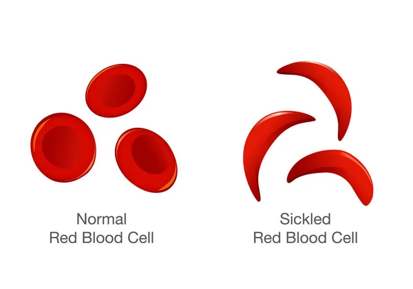 The difference of Normal red blood cell and sickle cell. — Stock Vector