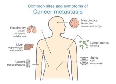 Most common sites and symptoms of Cancer Metastasis. clipart