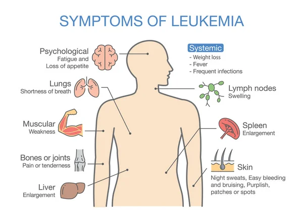 Sintomas e sinais frequentes de leucemia . — Vetor de Stock