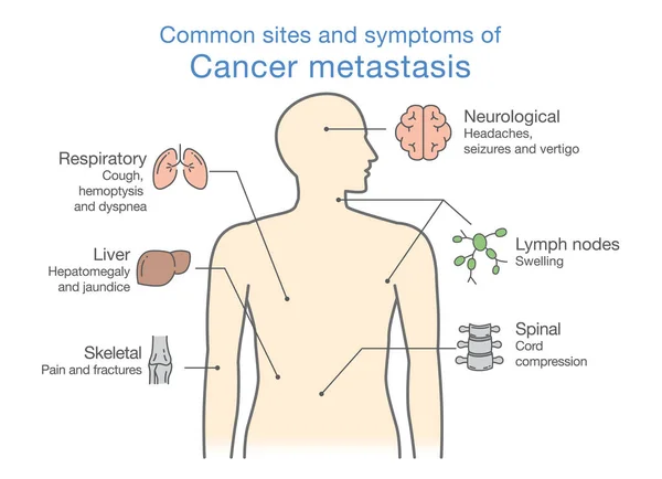 Najbardziej popularne witryny i objawy przerzutów raka. — Wektor stockowy