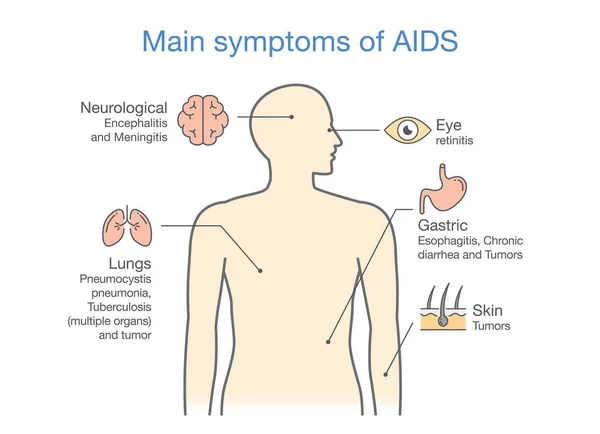 급성 Hiv 감염의 주요 증상. — 스톡 벡터