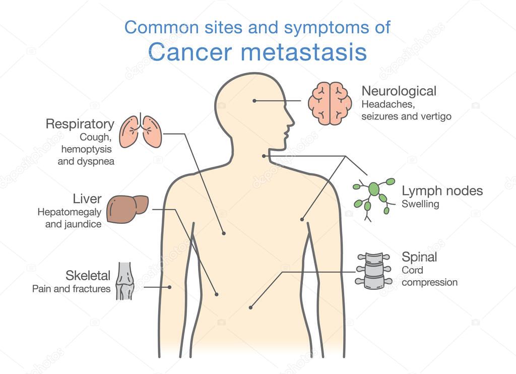 Most common sites and symptoms of Cancer Metastasis.