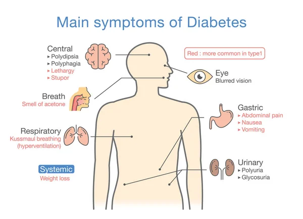 Hauptsymptome von Diabetes. — Stockvektor