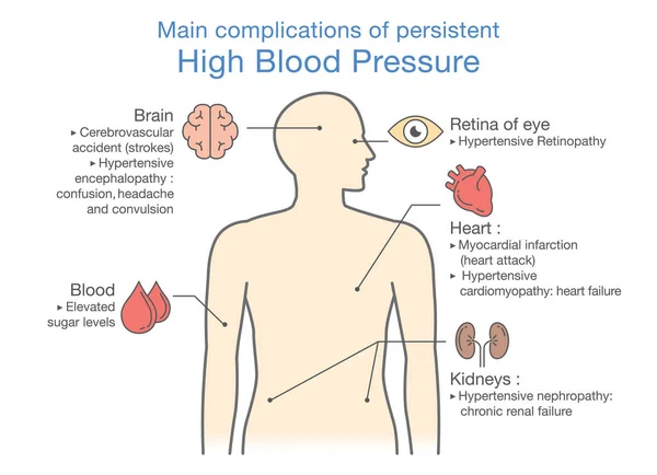 Huvudsakliga komplikationer av ihållande högt blodtryck. — Stock vektor