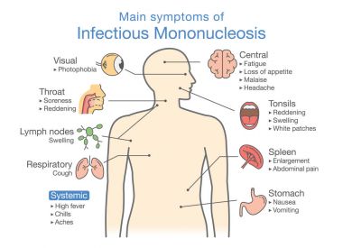Symptoms of Infectious Mononucleosis disease. clipart