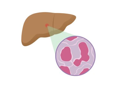 Siroz insan karaciğer hücreleri.