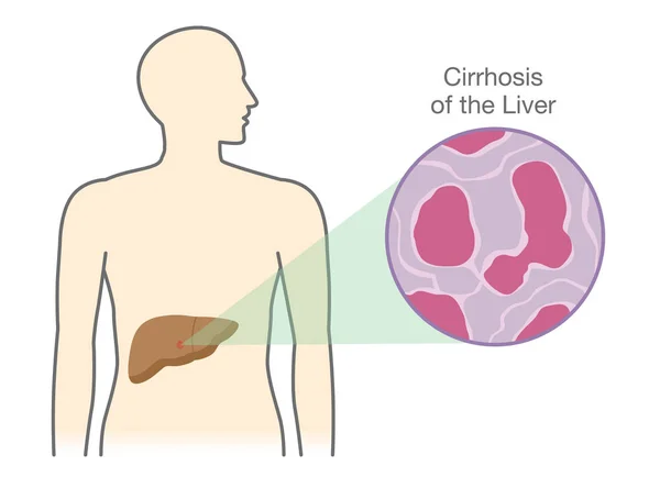 Mostrando células dañadas en el hígado de las personas con cirrosis . — Vector de stock