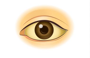 Yellowing in the human eye. clipart