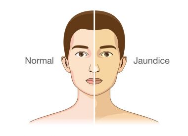 The Comparison between normal skin people and yellowing from Jaundice. clipart