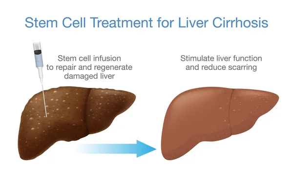Tratamiento de la cirrosis hepática con células madre . — Vector de stock