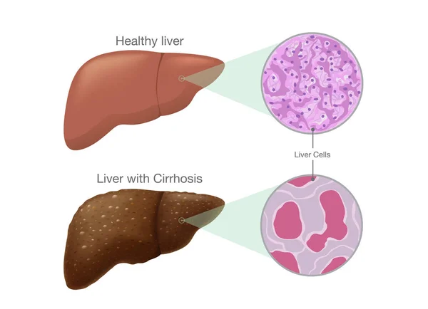 La diferencia de las células hepáticas sanas y la cirrosis . — Archivo Imágenes Vectoriales