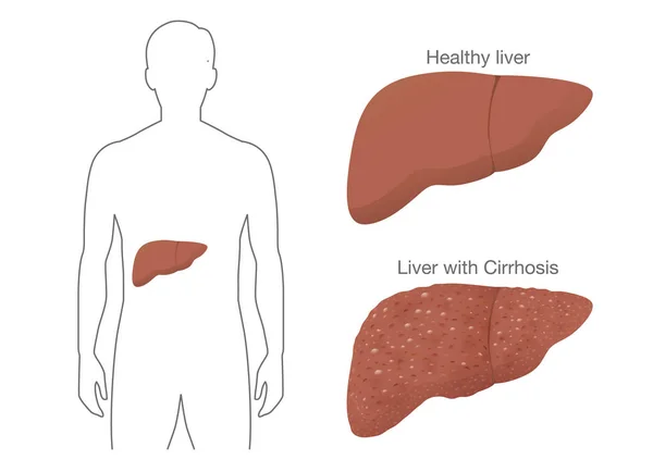 Comparación entre el hígado sano y la cirrosis . — Vector de stock