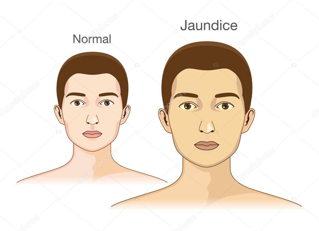 The Comparison between normal skin people and yellowing from Jaundice.