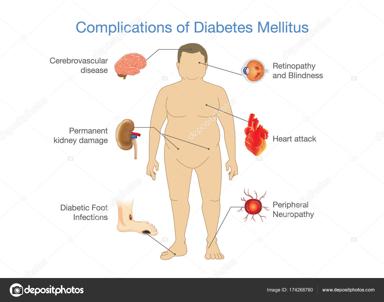 body fat 5 Stock in of Mellitus fat â Diabetes people. Complications body fat 5 Stock in of Mellitus fat â Diabetes people. Complications