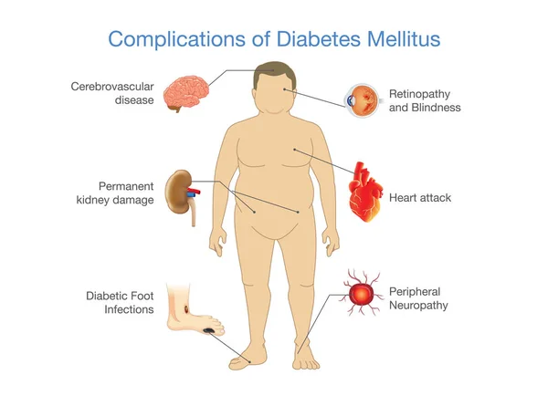Komplikationer av Diabetes Mellitus i feta människor. — Stock vektor