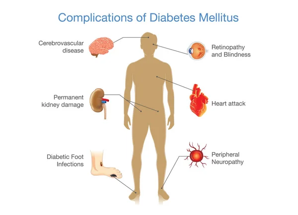 Complicações da Diabetes Mellitus nas pessoas . — Vetor de Stock