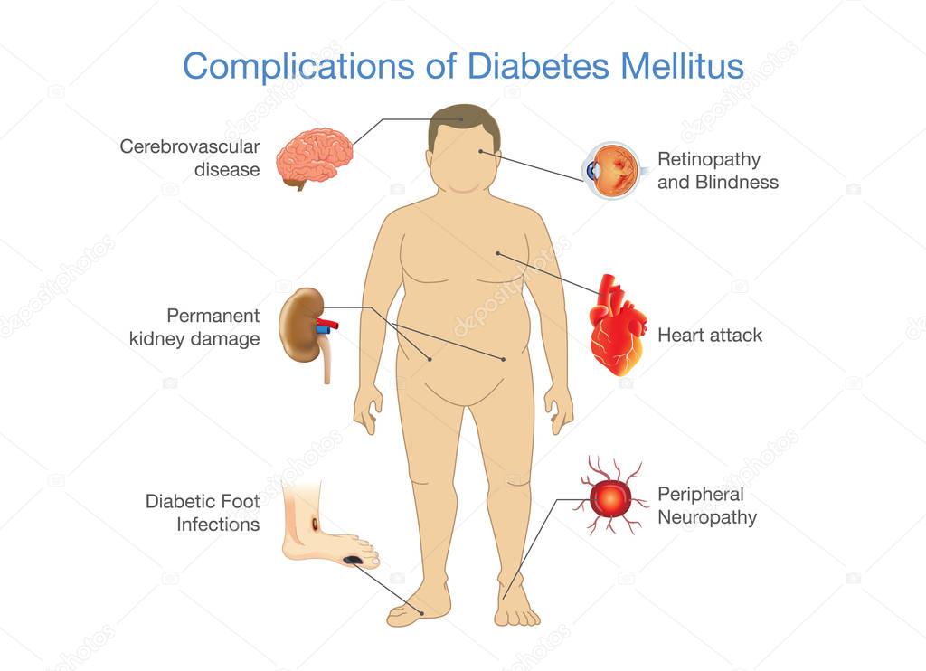 Complications of Diabetes Mellitus in fat people.