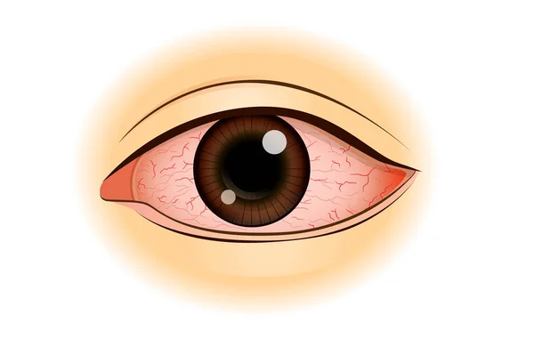 Симптом покраснения глаз азиатов . — стоковый вектор