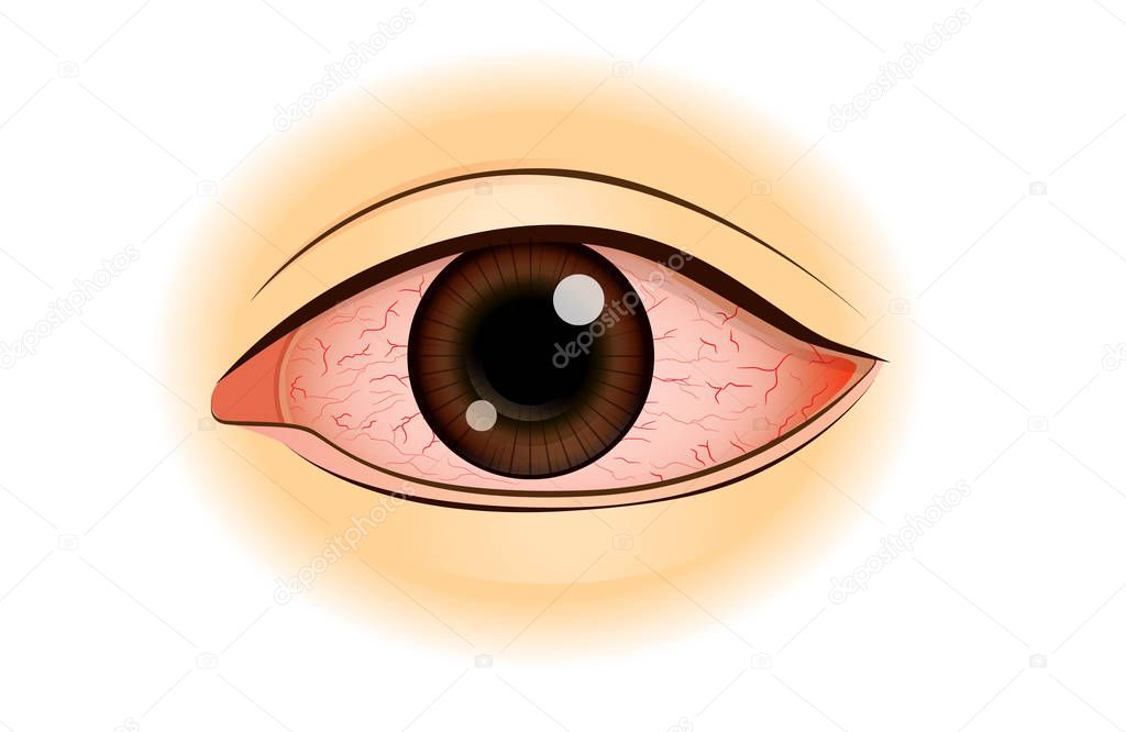 Eye redness symptom of Asian people.