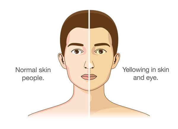 Сравнение между нормальными людьми и пожелтением глаз и кожи. Иллюстрация о проблемах со здоровьем
.