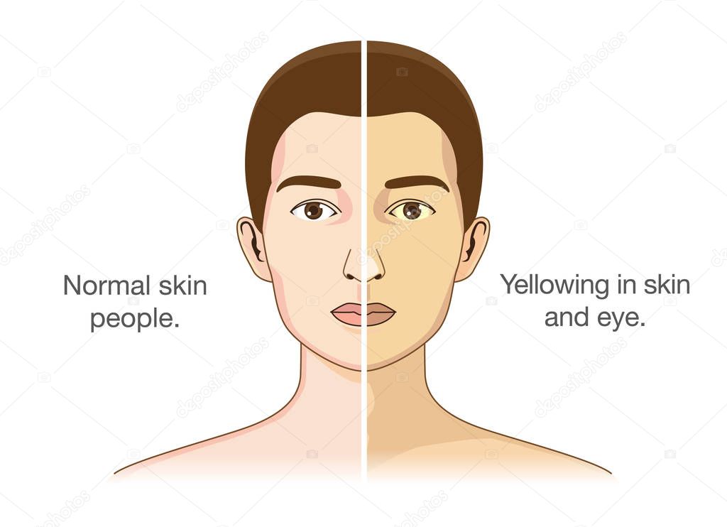 The Comparison between normal people and yellowing of the eyes and skin. Illustration about health problems.